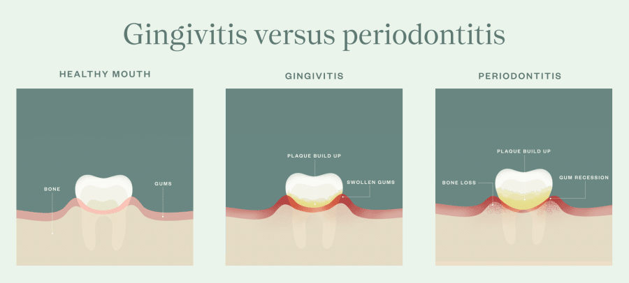 Graphics displaying the progression of gum disease from healthy to periodontitis.