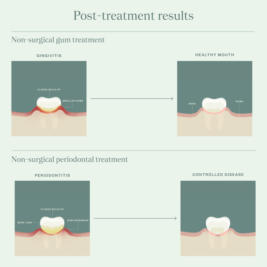 Illustration of before and after non-surgical gum treatment and non-surgical periodontal treatment.