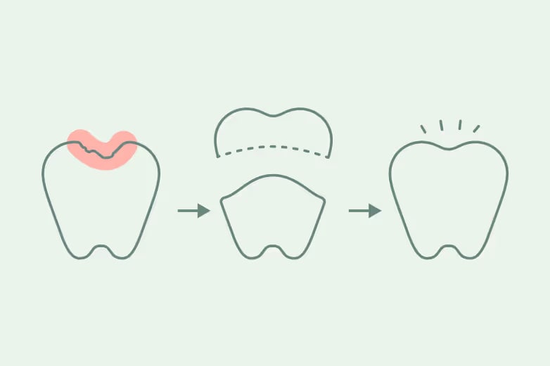 Illustration of 3 teeth; the first with red at the top indicating decay, the second with the decay removed and a portrayal of a crown hovering above, the third is a solid healthy looking tooth.