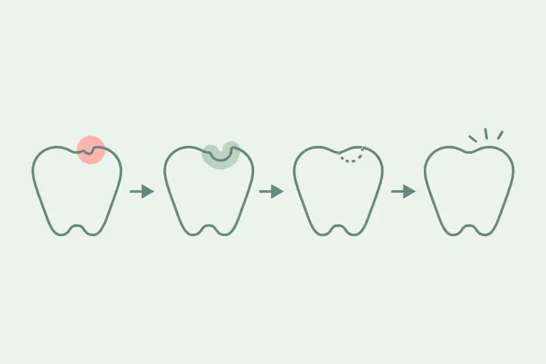 Illustration of tooth with small cavity, then one with the area drilled out, then the cavity is placed. Finally the tooth is whole again.