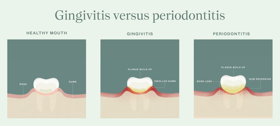 Illustration of the thee stages of gum disease: healthy mouth then gingivitis then periodontitis