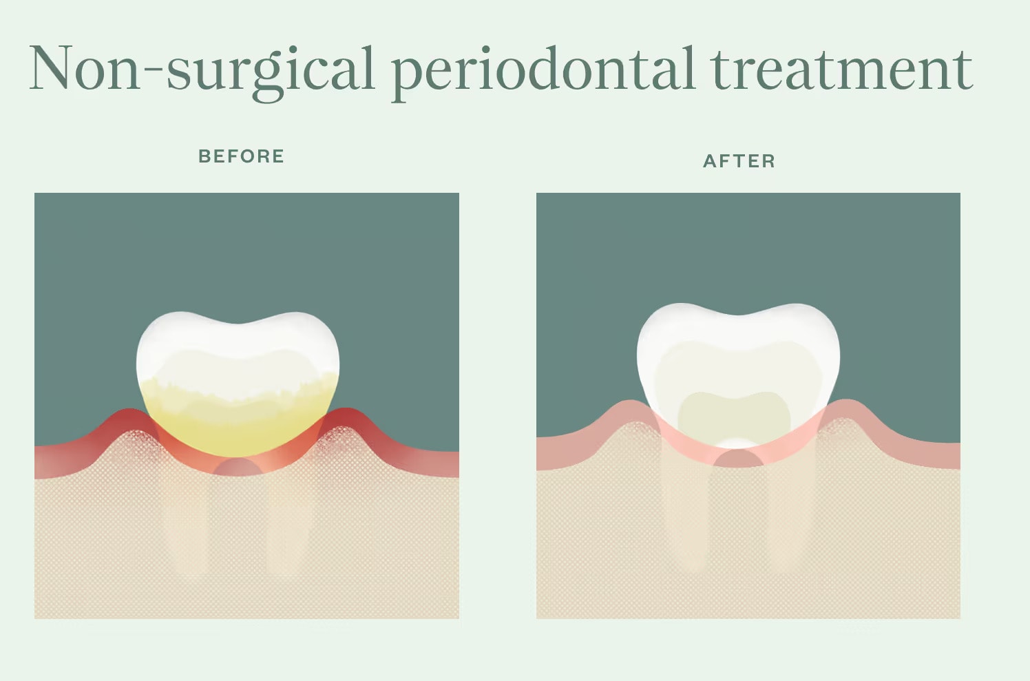 Illustration of showing inflammation of gums and buildup on tooth as before non-surgical periodontal treatment then an illustration of a clean white tooth and healthy pink gums after treatment.